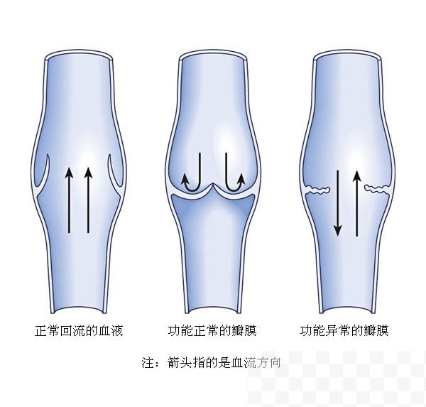 小腿静脉曲张的治疗方法如何治根